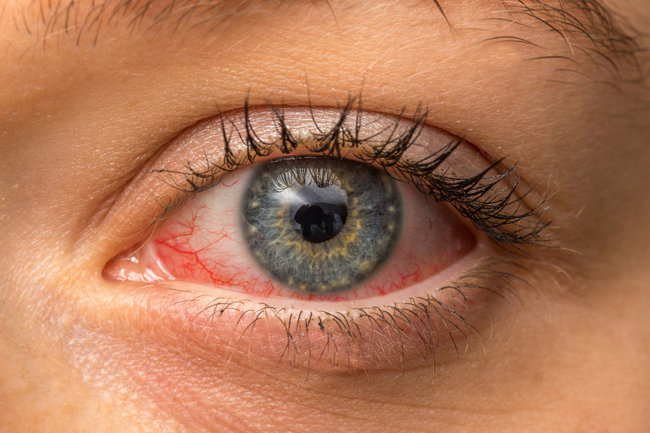 Allergie oculari: alcune curiosità